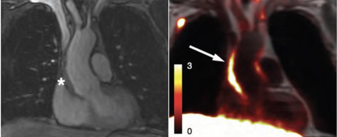 Images from a patient with LVV showing how PET and MR scanning can detect active inflammation of the main artery of the body, the aorta (highlighted with arrow)