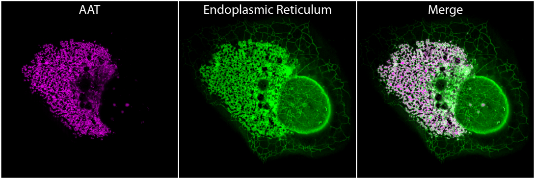 Shown is a super-resolution microscopy image (acquired by structures illumination microscopy) of a cell expressing mutant alpha-1-antitrypsin. The alpha-1-antitrypsin protein (shown in magenta) is trapped within the endoplasmic reticulum (shown in green), the compartment of the cell where it is synthesised.